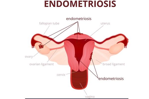 Untreated Endometriosis can silently kill chances of motherhood